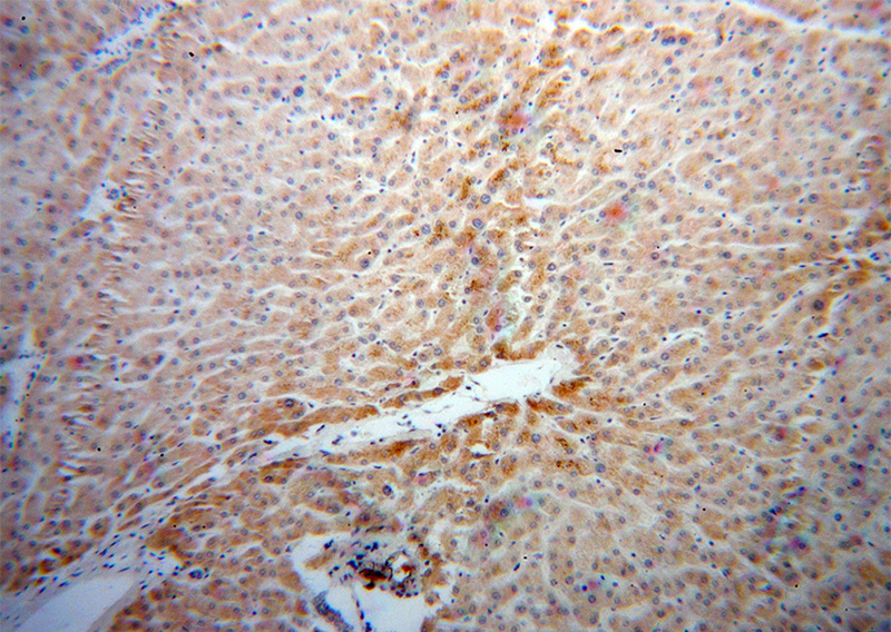 Immunohistochemical of paraffin-embedded human liver cancer using Catalog No:114563(RBP5 antibody) at dilution of 1:50 (under 10x lens)