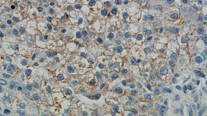 Immunohistochemical of paraffin-embedded human liver cancer using Catalog No:110025(DSE antibody) at dilution of 1:50 (under 40x lens)