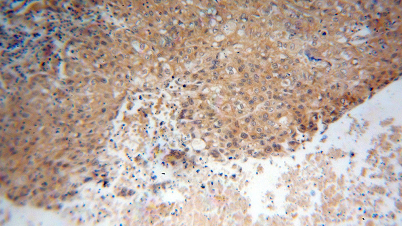 Immunohistochemical of paraffin-embedded human lung cancer using Catalog No:112032(KEAP1 antibody) at dilution of 1:100 (under 10x lens)