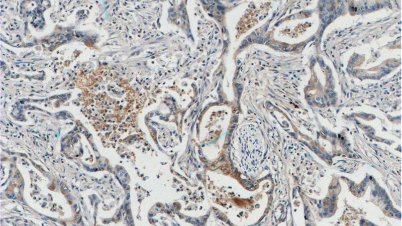 Immunohistochemistry of paraffin-embedded human pancreas cancer tissue slide using Catalog No:107763(ADAM17-Specific Antibody) at dilution of 1:200 (under 10x lens).