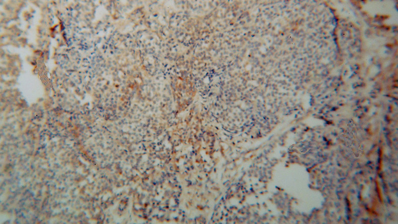 Immunohistochemical of paraffin-embedded human breast cancer using Catalog No:110412(EXOSC5 antibody) at dilution of 1:50 (under 10x lens)