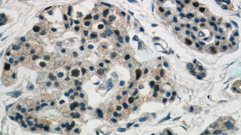 Immunohistochemistry of paraffin-embedded human pancreas cancer tissue slide using Catalog No:111941(Islet 1 Antibody) at dilution of 1:200 (under 40x lens)