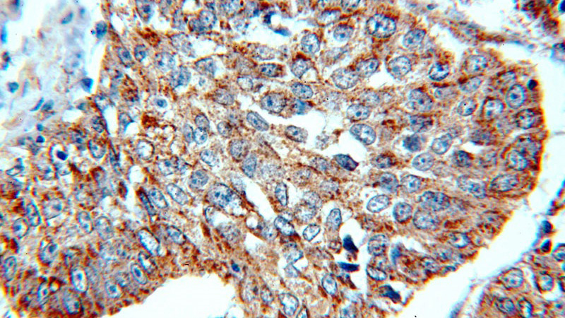 Immunohistochemical of paraffin-embedded human lung cancer using Catalog No:112126(KRT10-specific antibody) at dilution of 1:200 (under 40x lens)