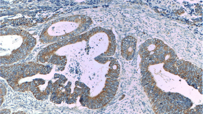 Immunohistochemistry of paraffin-embedded human colon cancer tissue slide using Catalog No:110449(FADS1 Antibody) at dilution of 1:200 (under 10x lens)