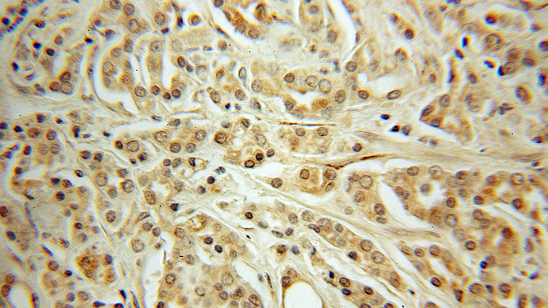 Immunohistochemical of paraffin-embedded human prostate cancer using Catalog No:109100(CDC27; APC3 antibody) at dilution of 1:50 (under 10x lens)