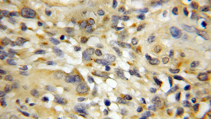 Immunohistochemical of paraffin-embedded human gliomas using Catalog No:115946(TERF1 antibody) at dilution of 1:50 (under 10x lens)