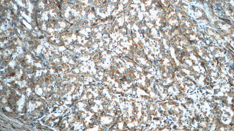 Immunohistochemistry of paraffin-embedded human prostate cancer slide using Catalog No:117195(BMP15 Antibody) at dilution of 1:50 (under 10x lens)