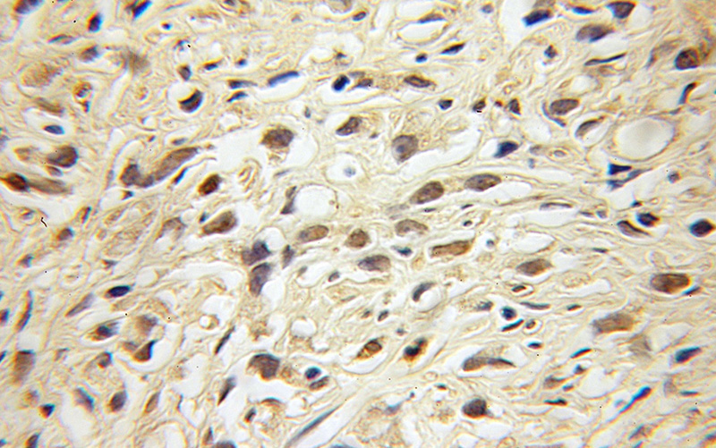 Immunohistochemical of paraffin-embedded human gliomas using Catalog No:108159(ARNT2 antibody) at dilution of 1:100 (under 10x lens)