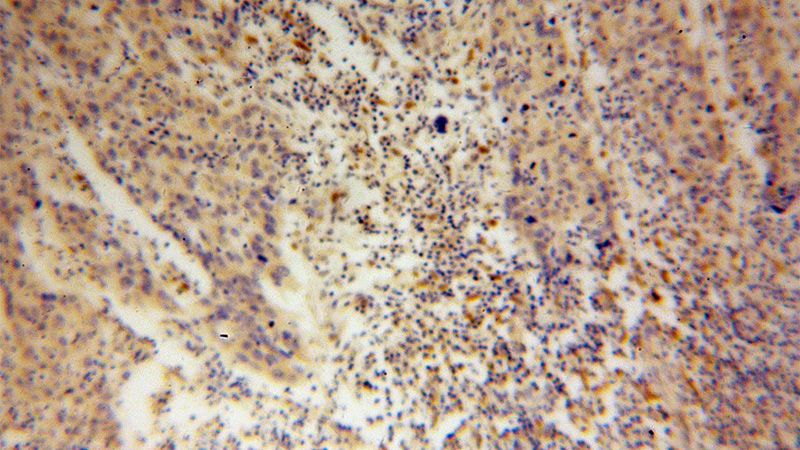 Immunohistochemical of paraffin-embedded human cervical cancer using Catalog No:114990(SCEL antibody) at dilution of 1:100 (under 10x lens)