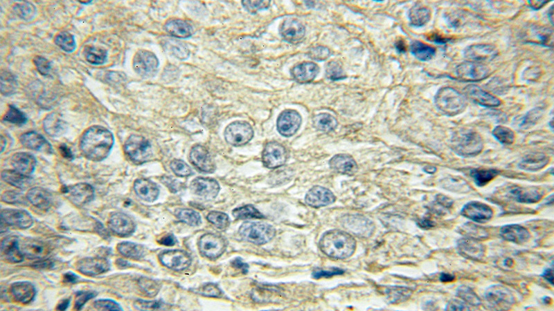 Immunohistochemical of paraffin-embedded human lung cancer using Catalog No:115354(SLCO6A1 antibody) at dilution of 1:50 (under 10x lens)