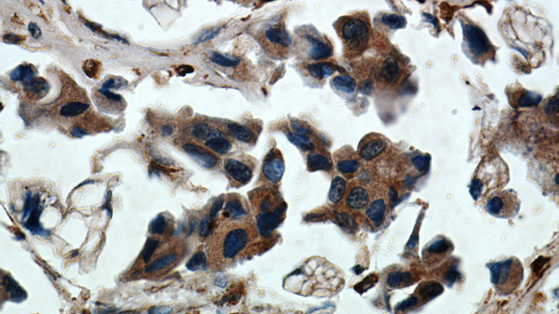 Immunohistochemical of paraffin-embedded human breast cancer using Catalog No:108887(CTSB antibody) at dilution of 1:50 (under 40x lens)