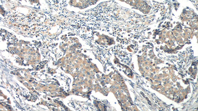Immunohistochemistry of paraffin-embedded human breast cancer tissue slide using Catalog No:114133(PPM1B Antibody) at dilution of 1:200 (under 10x lens)