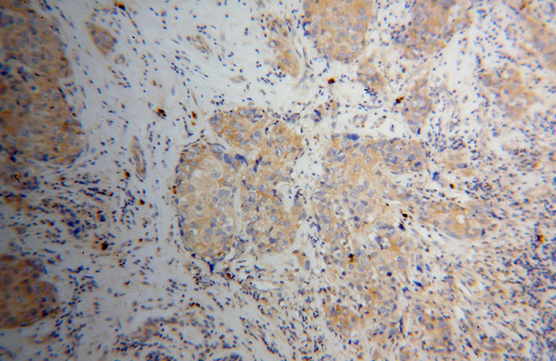 Immunohistochemical of paraffin-embedded human breast cancer using Catalog No:110444(FABP7-Specific antibody) at dilution of 1:100 (under 10x lens)