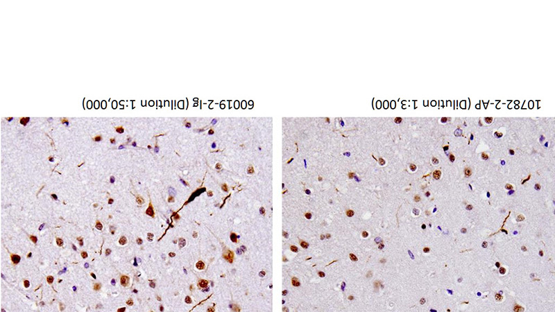 40X of FTLD-U case stained by Catalog No:115925 and Catalog No:107618, showing dystrophic neurites. (Figs were provided by Linda K. Kwong)