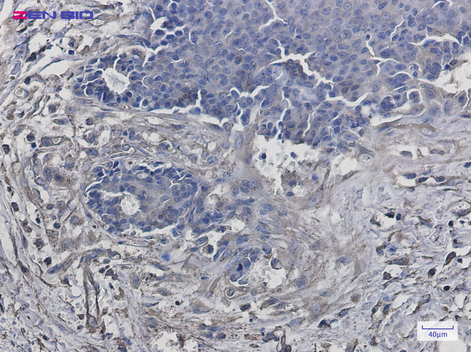 Immunohistochemistry of VPS4a in paraffin-embedded Human breast cancer tissue using VPS4a Rabbit pAb at dilution 1/50