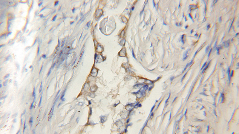 Immunohistochemical of paraffin-embedded human lung cancer using Catalog No:107837(GPSM1 antibody) at dilution of 1:50 (under 10x lens)