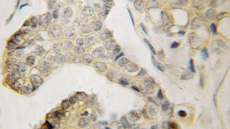 Immunohistochemical of paraffin-embedded human ovary tumor using Catalog No:108556(BVES antibody) at dilution of 1:100 (under 10x lens)