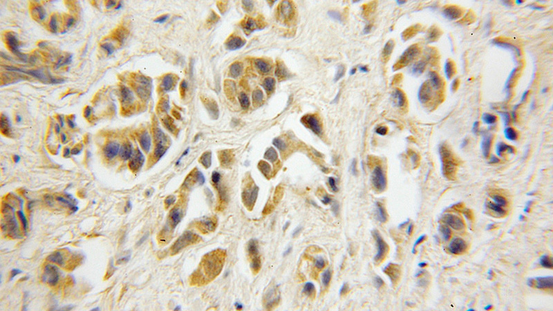 Immunohistochemical of paraffin-embedded human prostate cancer using Catalog No:115869(TBCA antibody) at dilution of 1:50 (under 10x lens)