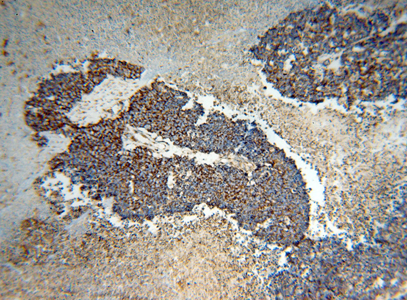 Immunohistochemical of paraffin-embedded human lung cancer using Catalog No:111567(HSPD1 antibody) at dilution of 1:100 (under 10x lens)