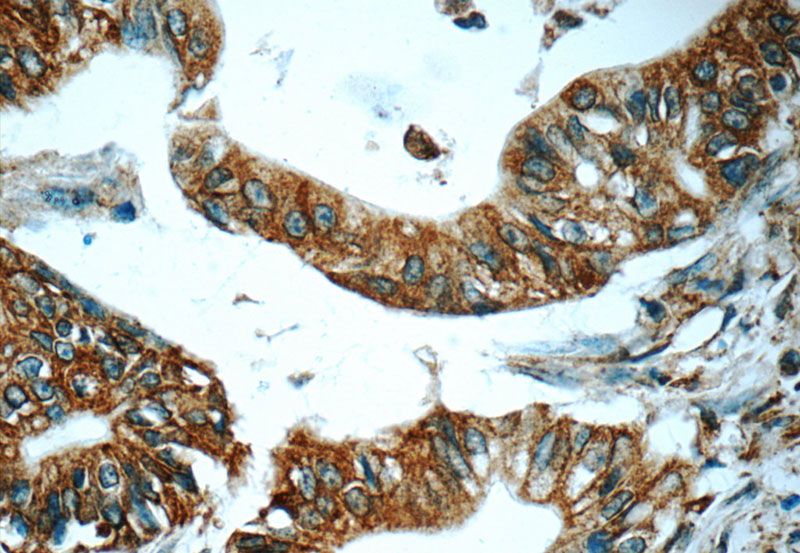 Immunohistochemistry of paraffin-embedded human pancreas cancer tissue slide using Catalog No:115850(TAP1 Antibody) at dilution of 1:50 (under 40x lens)