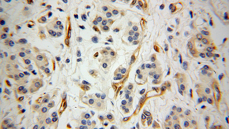 Immunohistochemical of paraffin-embedded human pancreas cancer using Catalog No:114521(RDX antibody) at dilution of 1:100 (under 40x lens)