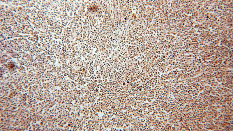 Immunohistochemical of paraffin-embedded human lymphoma using Catalog No:111480(HMGB2 antibody) at dilution of 1:50 (under 10x lens)