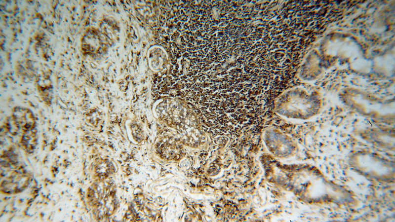Immunohistochemical of paraffin-embedded human stomach cancer using Catalog No:111414(HLA class I (HLA-A) antibody) at dilution of 1:100 (under 10x lens)