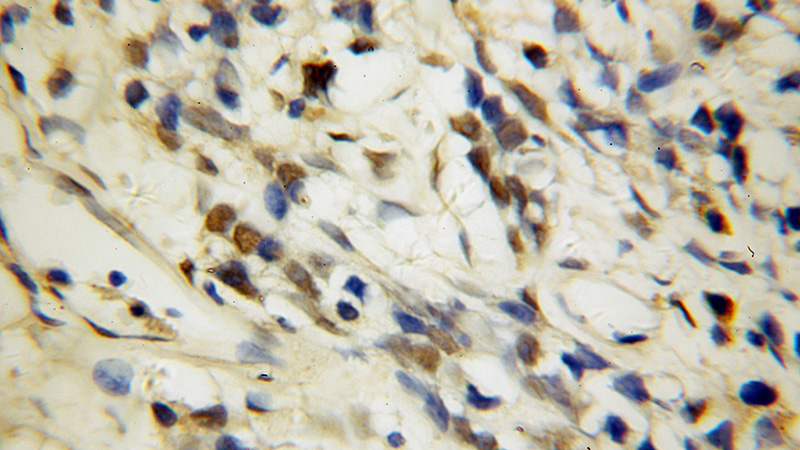Immunohistochemical of paraffin-embedded human prostate cancer using Catalog No:116462(U2AF35 antibody) at dilution of 1:100 (under 40x lens)