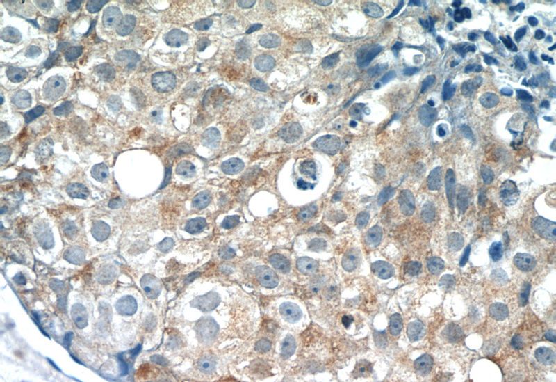 Immunohistochemistry of paraffin-embedded human breast cancer tissue slide using Catalog No:113479(PACSIN2 Antibody) at dilution of 1:400 (under 40x lens)