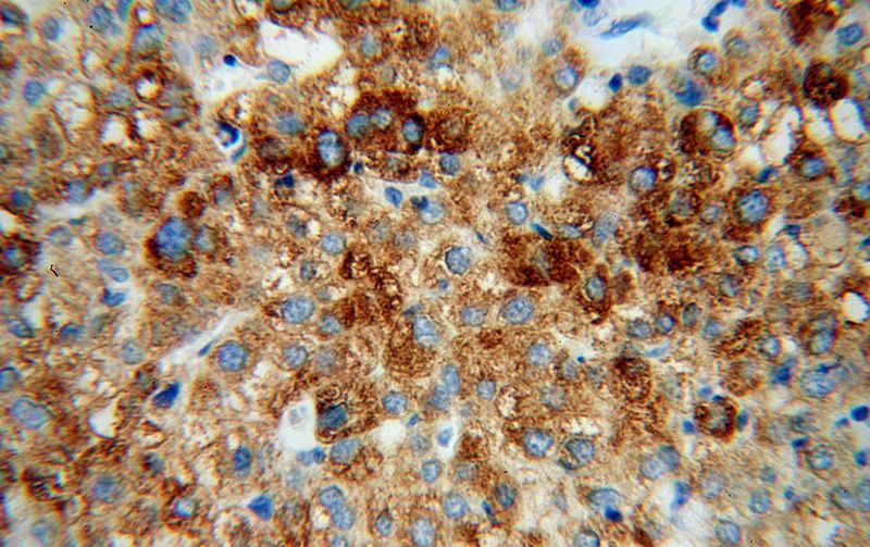 Immunohistochemical of paraffin-embedded human liver cancer using Catalog No:109705(CYP4F11 antibody) at dilution of 1:100 (under 40x lens)