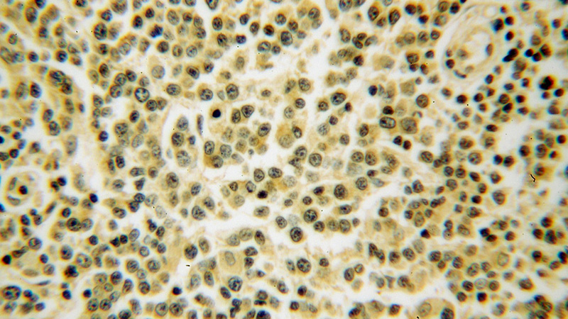Immunohistochemical of paraffin-embedded human lymphoma using Catalog No:116144(TNIP1 antibody) at dilution of 1:50 (under 40x lens)