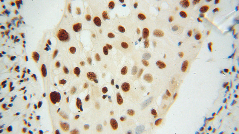 Immunohistochemical of paraffin-embedded human cervical cancer using Catalog No:115459(SNRPB2 antibody) at dilution of 1:100 (under 40x lens)