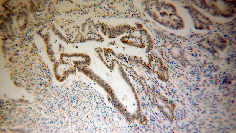 Immunohistochemical of paraffin-embedded human colon cancer using Catalog No:114768(RNMT antibody) at dilution of 1:50 (under 10x lens)
