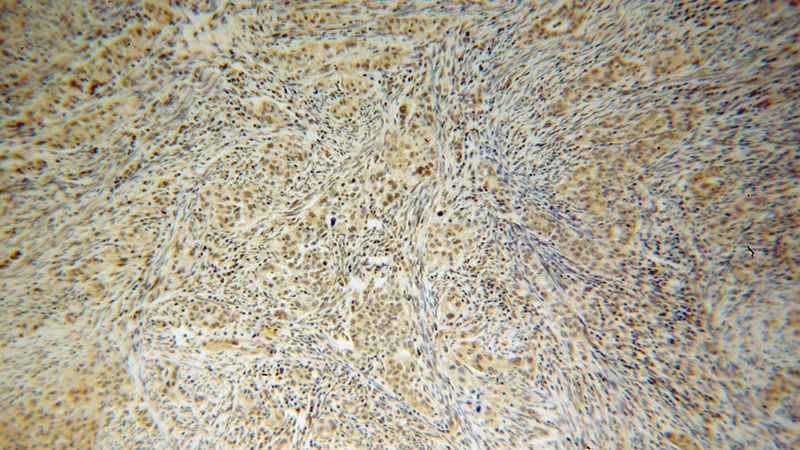 Immunohistochemical of paraffin-embedded human endometrial cancer using Catalog No:111435(HLX antibody) at dilution of 1:100 (under 10x lens)