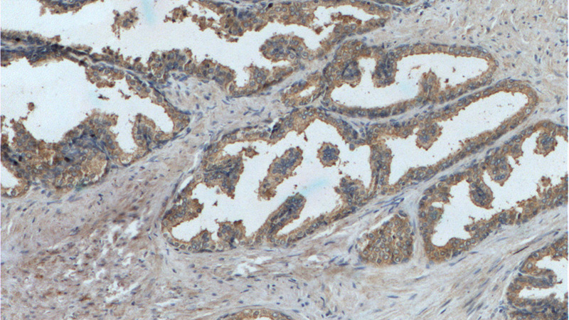 Immunohistochemistry of paraffin-embedded human prostate hyperplasia tissue slide using Catalog No:114269(PTGER4 Antibody) at dilution of 1:200 (under 10x lens).