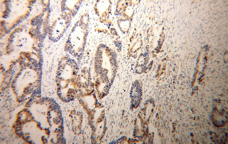 Immunohistochemical of paraffin-embedded human colon cancer using Catalog No:116010(TFEC antibody) at dilution of 1:100 (under 10x lens)