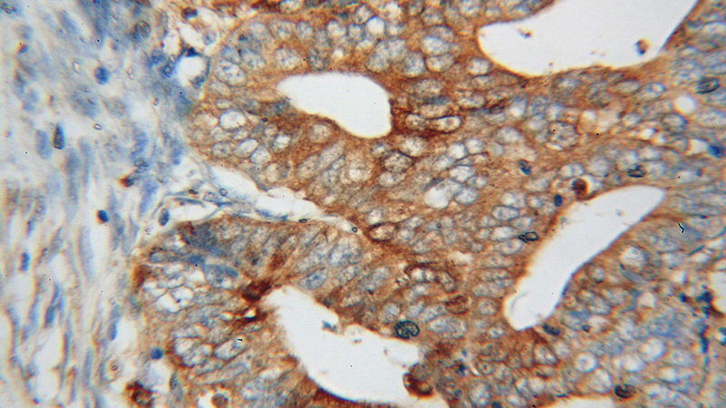 Immunohistochemical of paraffin-embedded human endometrial cancer using Catalog No:110891(GBP1 antibody) at dilution of 1:50 (under 40x lens)