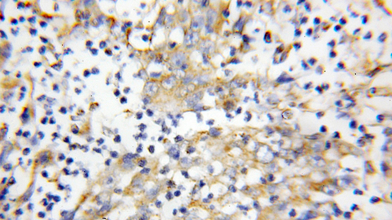 Immunohistochemical of paraffin-embedded human colon cancer using Catalog No:116468(UBA5 antibody) at dilution of 1:100 (under 10x lens)