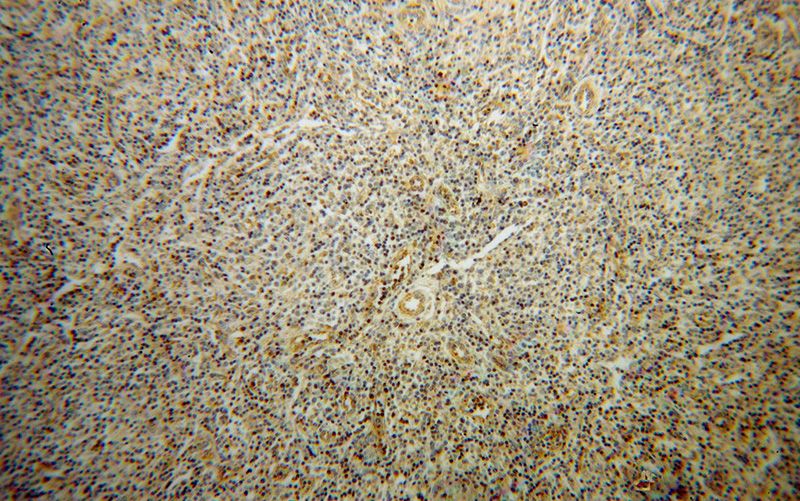Immunohistochemical of paraffin-embedded human lymphoma using Catalog No:111160(GZMA antibody) at dilution of 1:50 (under 10x lens)