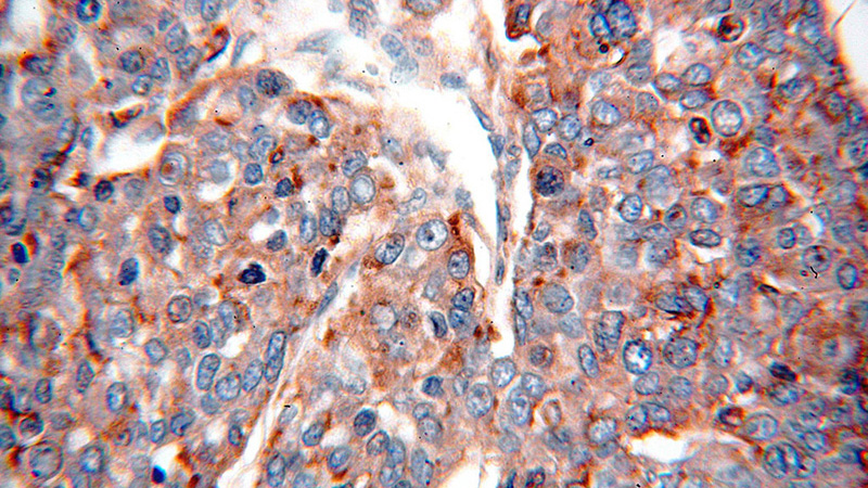Immunohistochemical of paraffin-embedded human liver cancer using Catalog No:114291(PSAP antibody) at dilution of 1:100 (under 40x lens)