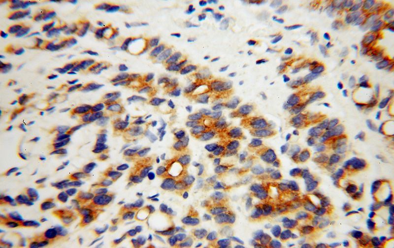 Immunohistochemical of paraffin-embedded human gliomas using Catalog No:114439(RAB3A antibody) at dilution of 1:100 (under 40x lens)