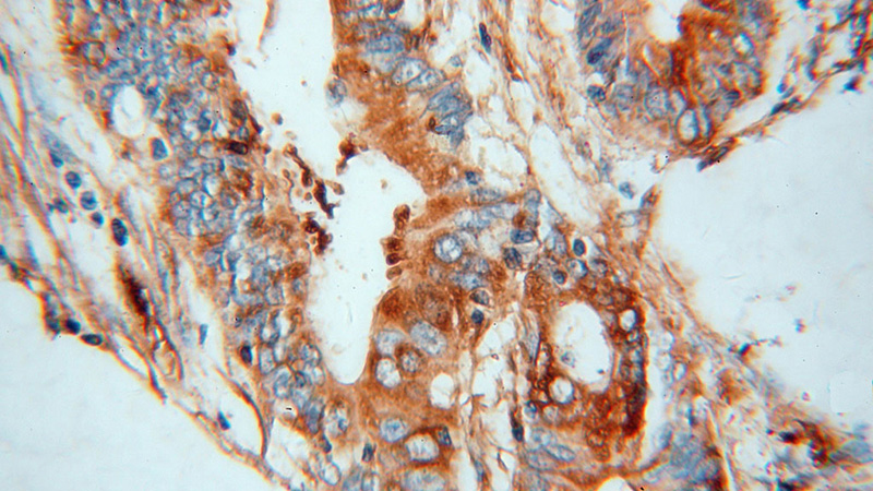 Immunohistochemical of paraffin-embedded human colon cancer using Catalog No:112970(MYL9 antibody) at dilution of 1:50 (under 40x lens)