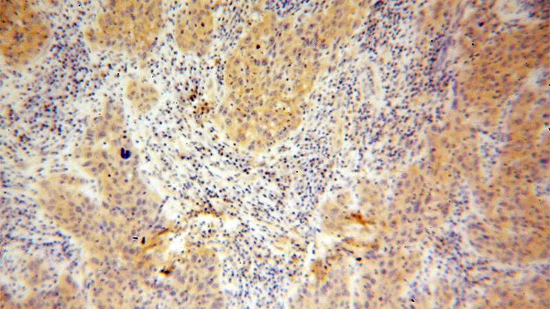 Immunohistochemical of paraffin-embedded human cervical cancer using Catalog No:109370(COG7 antibody) at dilution of 1:100 (under 10x lens)