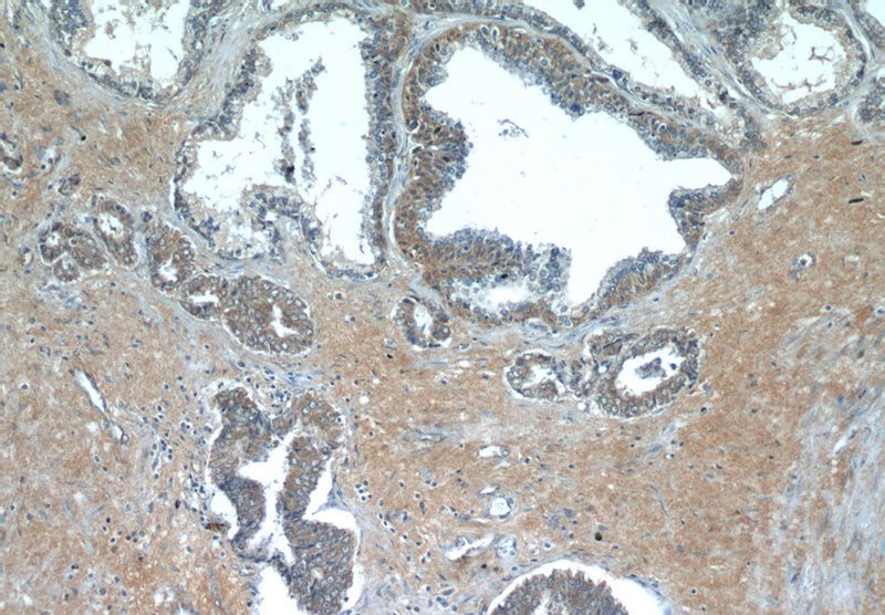 Immunohistochemistry of paraffin-embedded human prostate hyperplasia tissue slide using Catalog No:112421(LZTS2 Antibody) at dilution of 1:50 (under 10x lens)
