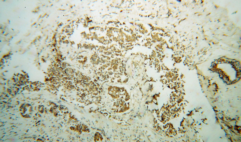 Immunohistochemical of paraffin-embedded human breast cancer using Catalog No:109919(DHODH antibody) at dilution of 1:100 (under 10x lens)
