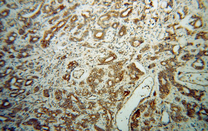 Immunohistochemical of paraffin-embedded human gliomas using Catalog No:110269(EIF5B antibody) at dilution of 1:100 (under 10x lens)