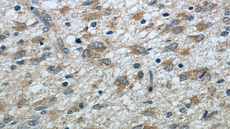 Immunohistochemical of paraffin-embedded human gliomas using Catalog No:109676(CYFIP2 antibody) at dilution of 1:50 (under 40x lens)