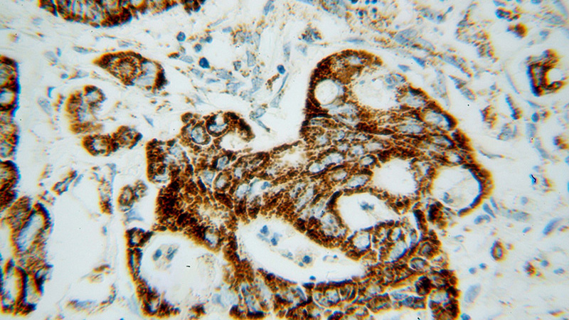Immunohistochemical of paraffin-embedded human colon cancer using Catalog No:112811(MRPL12 antibody) at dilution of 1:100 (under 40x lens)