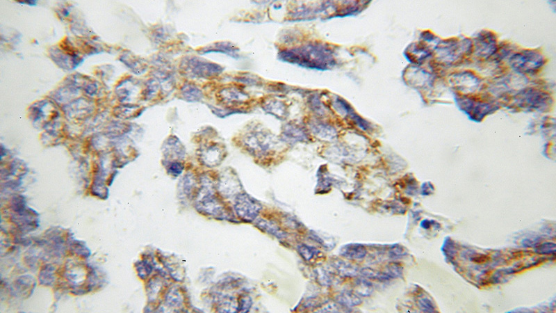 Immunohistochemical of paraffin-embedded human ovary tumor using Catalog No:112690(MMAB antibody) at dilution of 1:50 (under 10x lens)