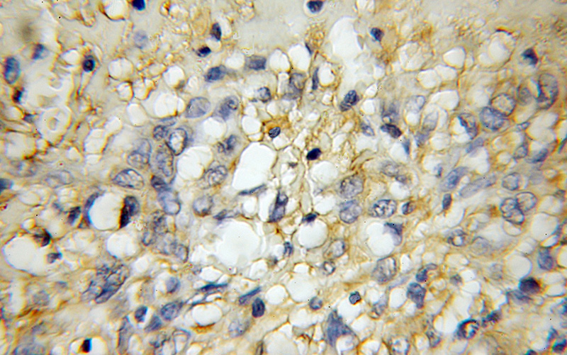 Immunohistochemical of paraffin-embedded human gliomas using Catalog No:111111(GPR137 antibody) at dilution of 1:50 (under 10x lens)